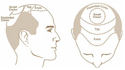 SELECT THE AREAS OF YOUR SCALP WHERE YOU NEED HAIR RESTORATION